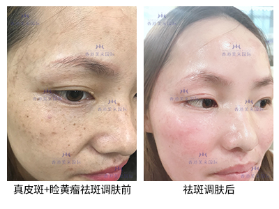 祛斑案例-美膚來（深圳）生物科技有限公司