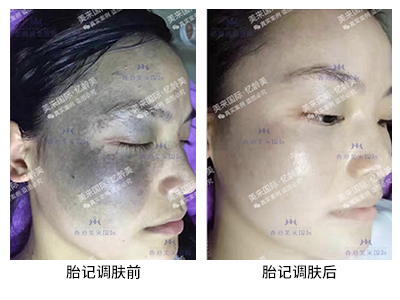 胎記技術(shù)調(diào)膚案例-美膚來(lái)（深圳）生物科技有限公司