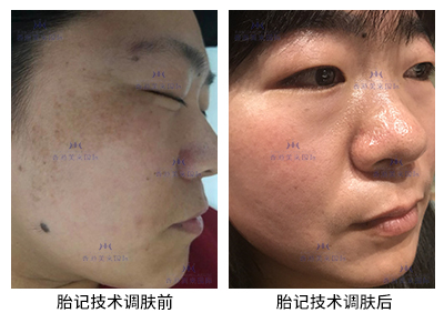 胎記技術(shù)調(diào)膚案例-美膚來(lái)（深圳）生物科技有限公司